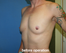 plastic-surgery-breast-augmentation